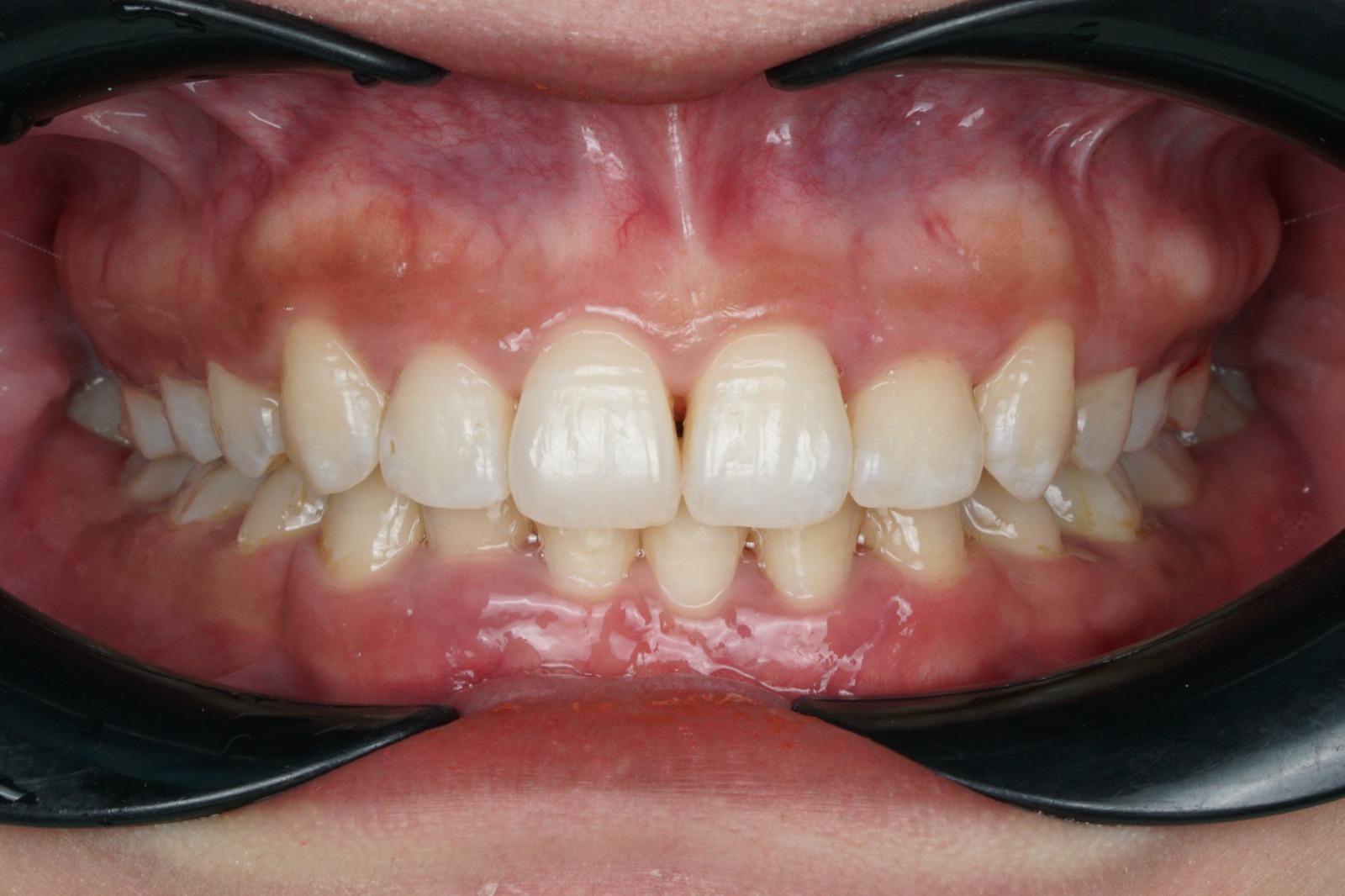 After - Conventional Braces