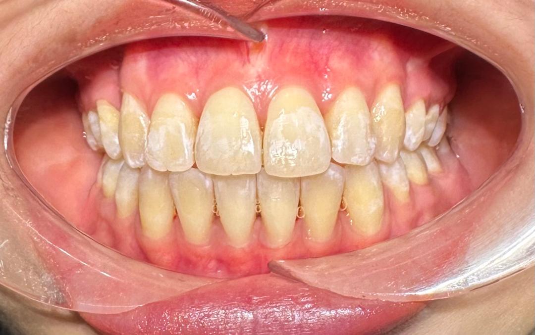 After - Conventional Braces