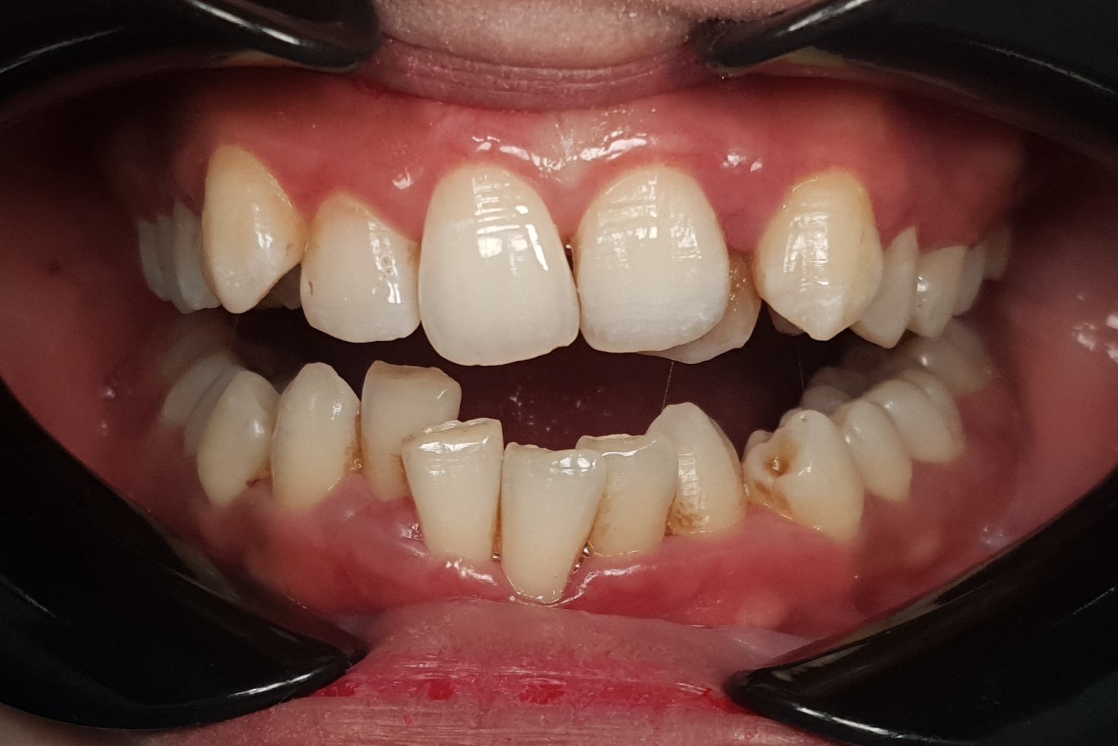 Before - Conventional Braces