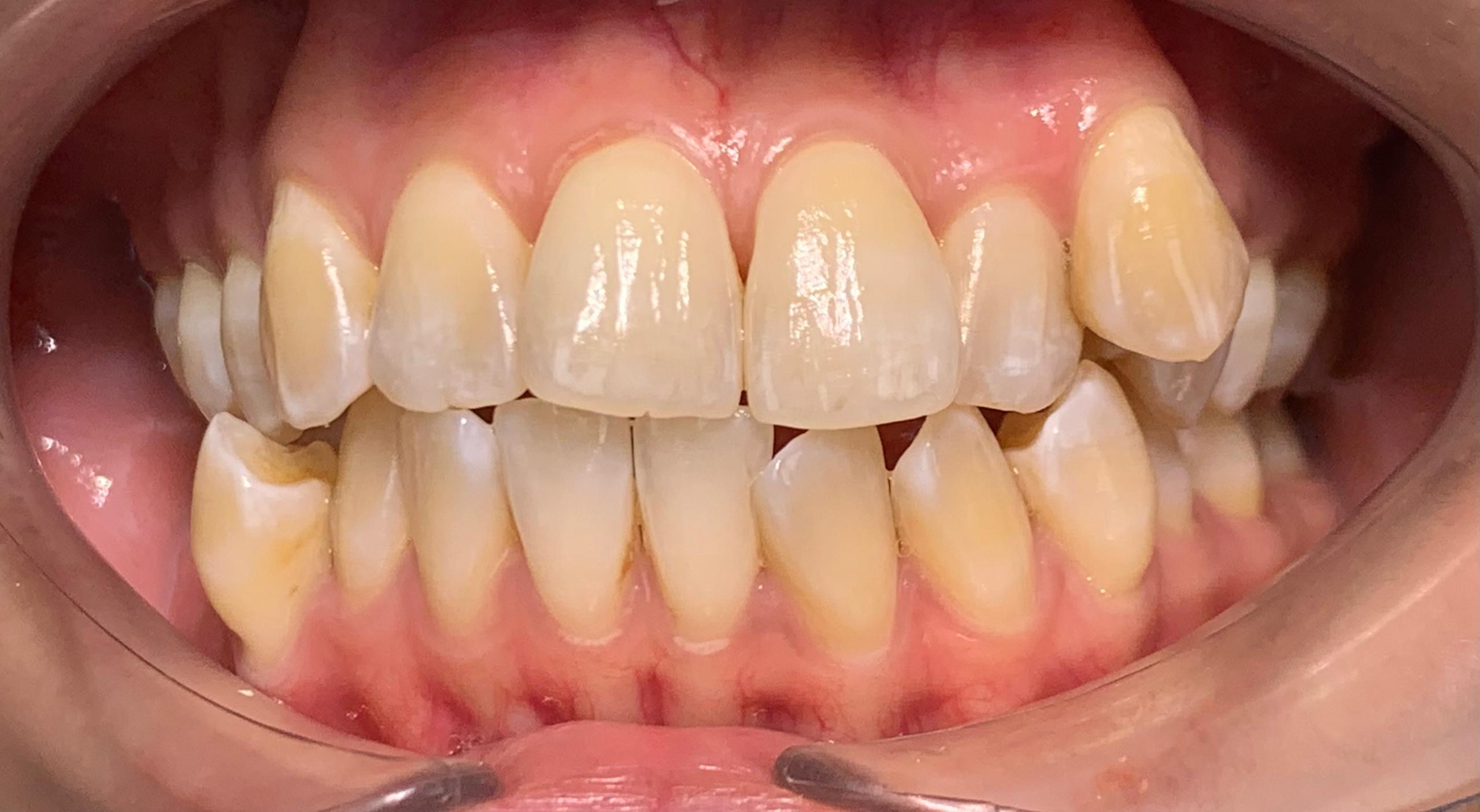 Before - Conventional Braces
