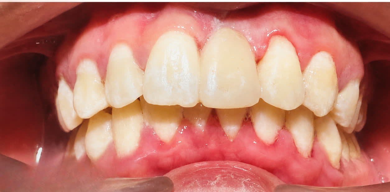 After - Fiber Reinforced Composite