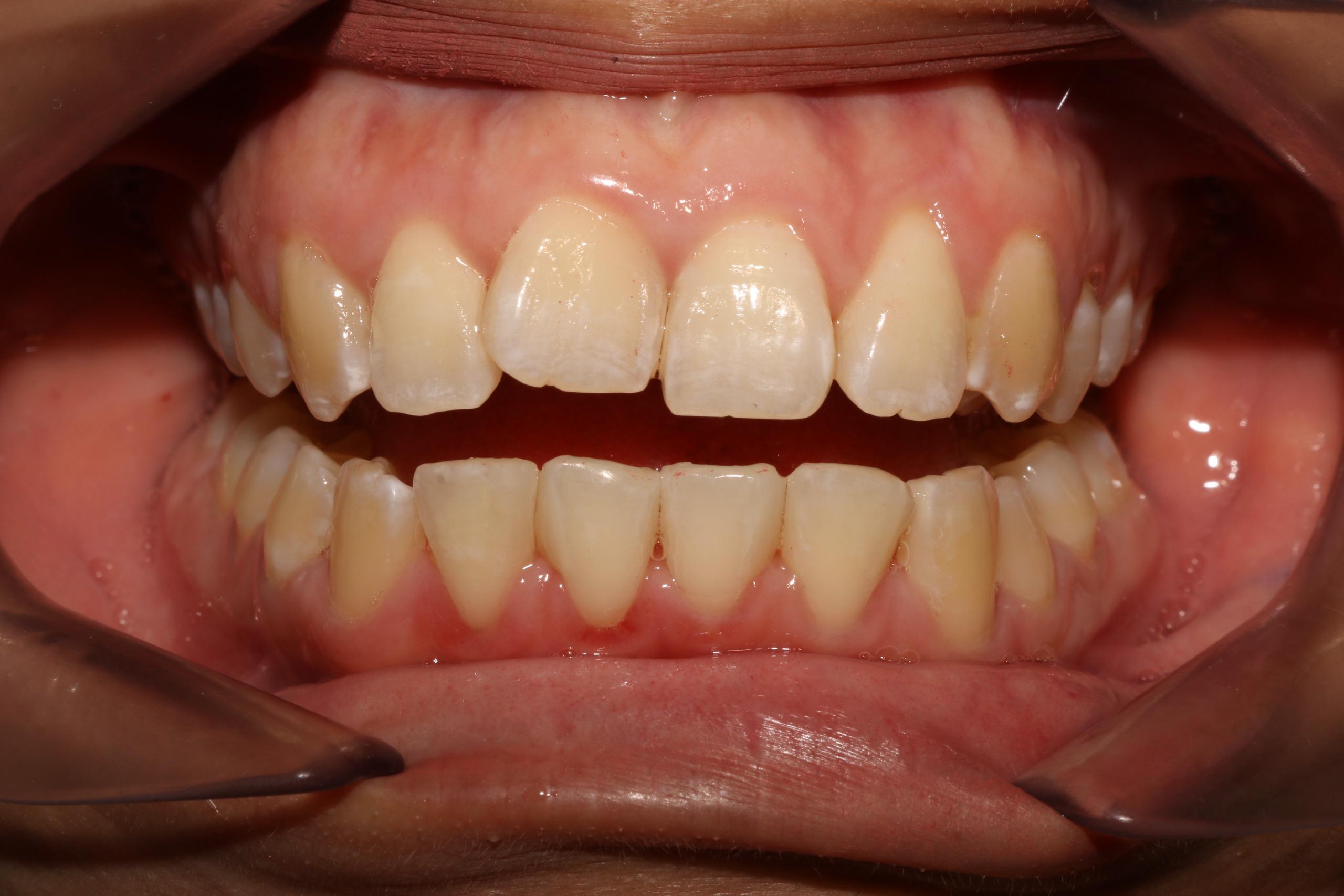 After - Veneer