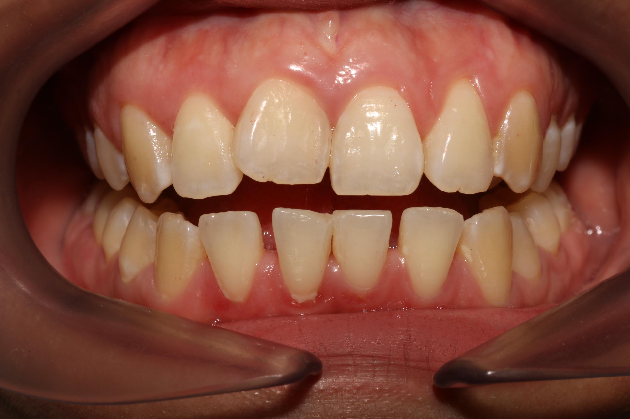 Before - Veneer