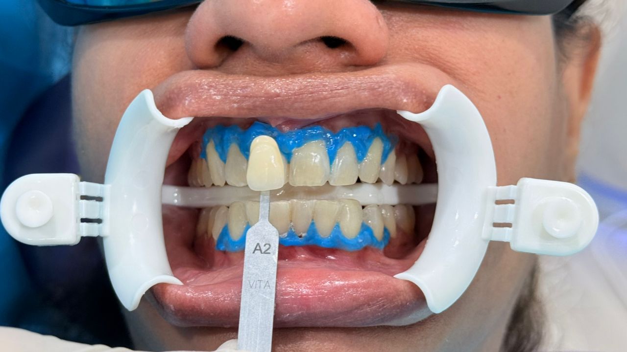 After - Whitening