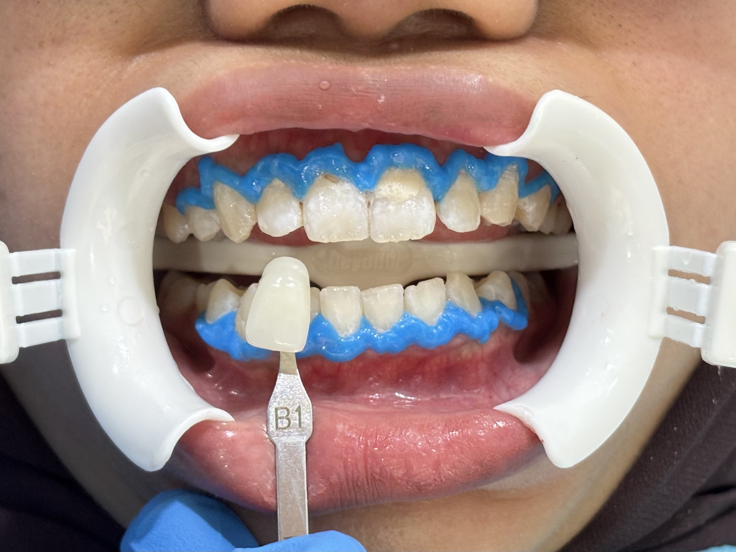 After - Whitening