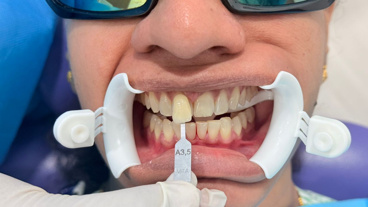 Before - Whitening