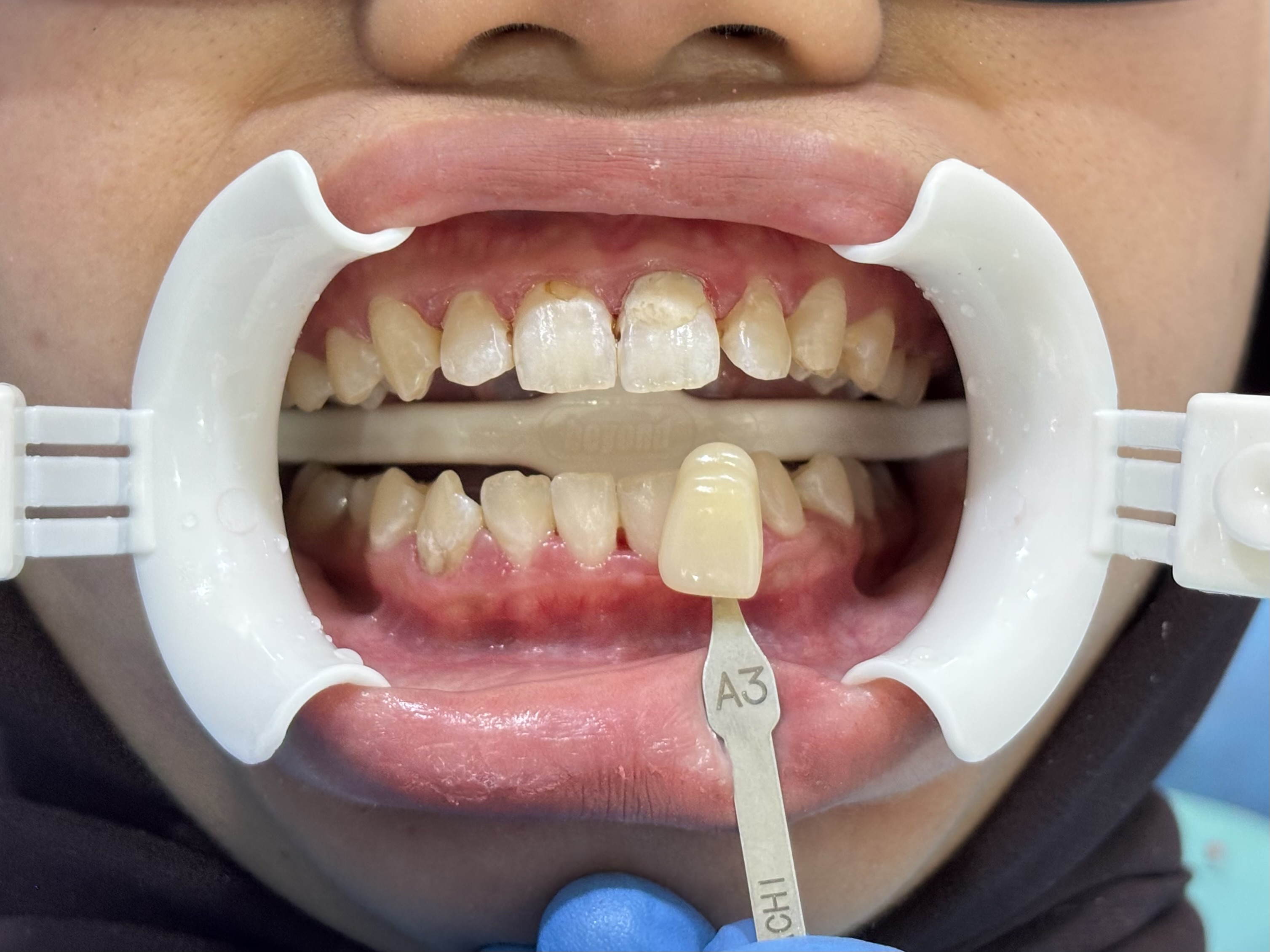 Before - Whitening